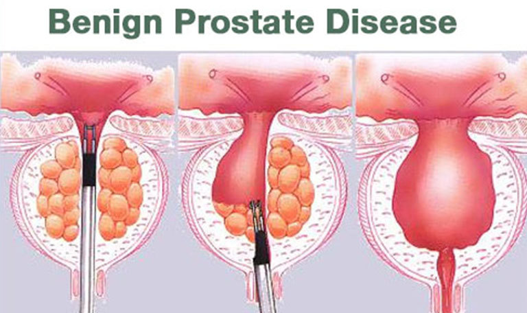 Shree Laxminarayan Hospital | Prostate Cancer Treatment in Nashik