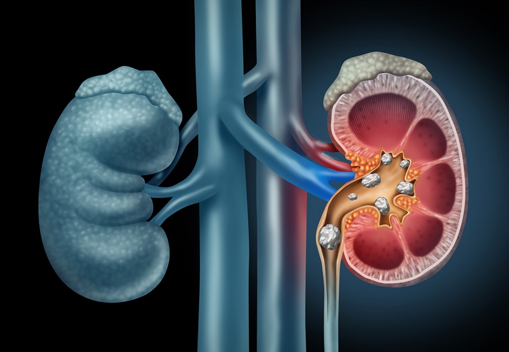 Dr. Chintaman Chaudhari Kidney Stone Specialist in Nashik