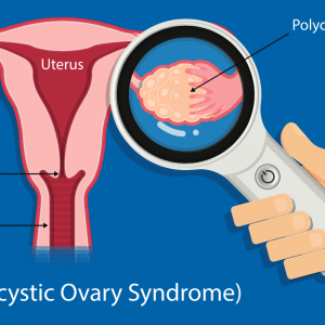 PCOS Treatment in Nashik | Shree Laxminarayan Hospital.