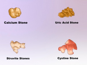 Kidney Stone Specialist Dr. Chintaman Chaudhari