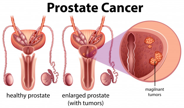 Prostate Cancer- Symptoms and Causes | Dr. Chintaman Chaudhari